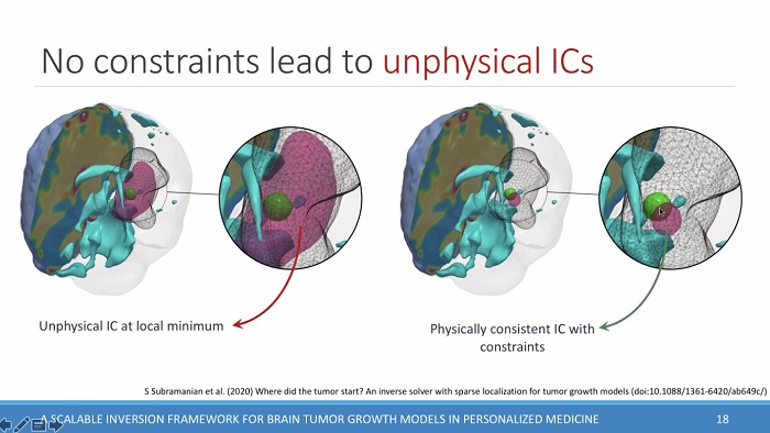 Different visualisations of areas of the brain with computed source areas of brain tumor growth (higlighted in red).