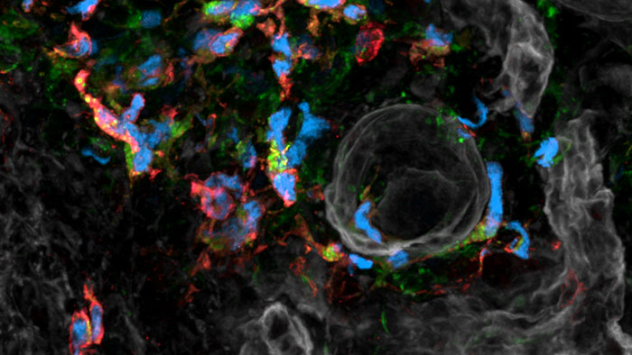 Eine Aufnahme zeigt sogenannte dendritische Zellen im Tumor-Gewebe mittels Immunfluoreszenz-Mikroskopie.